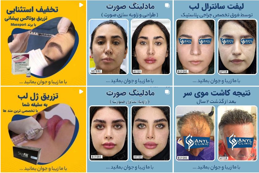 کلینیک کاشت مو آنیل